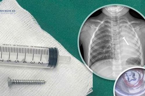 Cấp cứu thành công cho cháu bé nuốt phải cây đinh vít nhọn