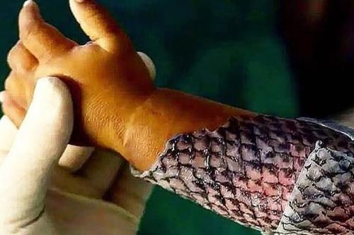 Da cá giúp điều trị bỏng và vết thương mãn tính