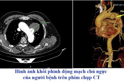 Nhiều người bệnh nặng được cứu sống nhờ kỹ thuật Hybrid tại Bệnh viện Đa khoa tỉnh