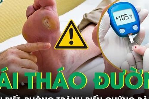 Biến chứng bàn chân tiểu đường: nhận biết để phòng ngừa!
