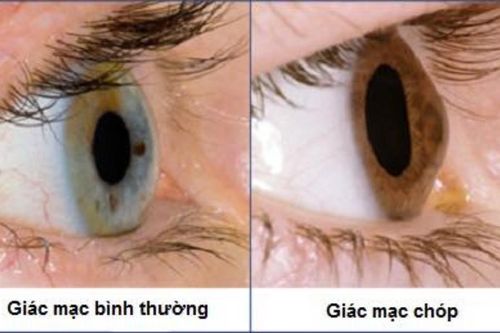 Bệnh giác mạc chóp: Nguyên nhân, biểu hiện, cách điều trị và phòng bệnh