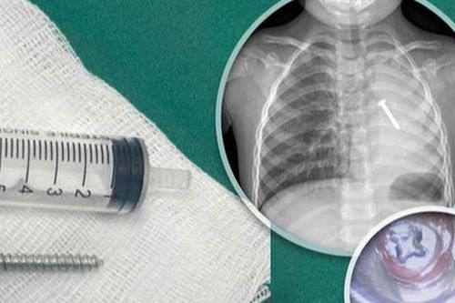 Cứu cháu bé nuốt cây đinh vít nhọn