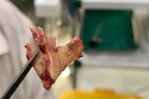 Gắp thành công mảnh xương nằm trong mũi người bệnh