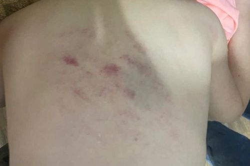 Thông tin về vụ giáo viên chủ nhiệm đánh học sinh lớp 1 bầm tím người