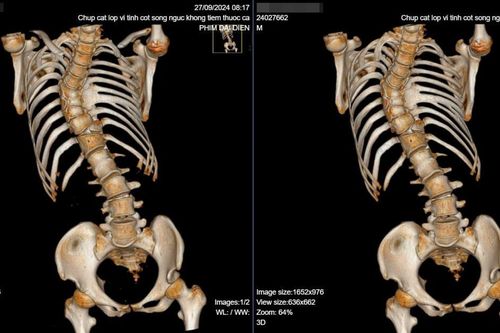 Phẫu thuật thành công chỉnh vẹo cột sống bẩm sinh cho nam bệnh nhân 23 tuổi