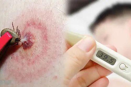 Babesia: Nguyên nhân, biểu hiện, cách điều trị và phòng bệnh