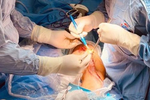 Ca phẫu thuật kéo dài 9 tiếng liên tục, giữ lại chân cho thanh niên 20 tuổi bị ung thư xương