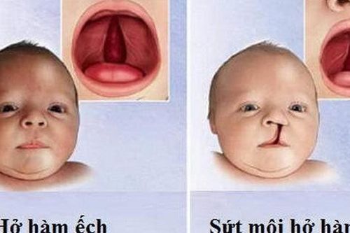 Luyện tập, vật lý trị liệu tốt cho người bệnh hở hàm ếch