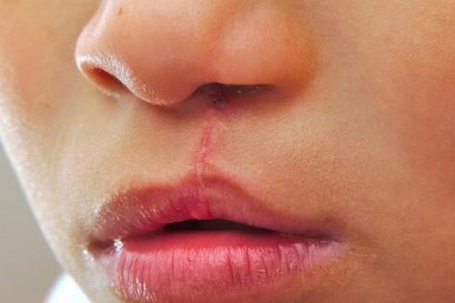 Hở hàm ếch điều trị như thế nào?