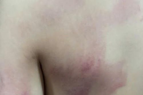 Nữ giáo viên bị đình chỉ công tác 3 tháng vì đánh học sinh bầm lưng