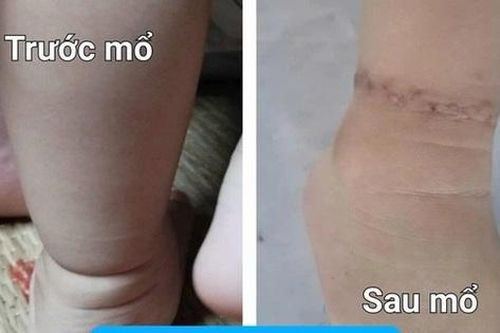 Tin tức Đời sống 22/10: Cha mẹ cần phân biệt rõ tay chân con có ngấn do bụ bẫm và bệnh này