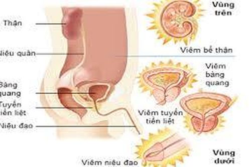 Làm thế nào để hết triệu chứng viêm niệu đạo kích thích sau khi điều trị viêm niệu đạo?