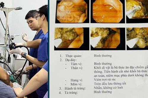 Người đàn ông 38 tuổi đau bụng dữ dội, nhập viện cấp cứu do thói quen ăn uống sai lầm nhiều người Việt mắc phải
