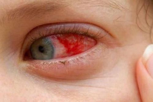Bệnh võng mạc: Nguyên nhân, triệu chứng, phòng bệnh và cách điều trị