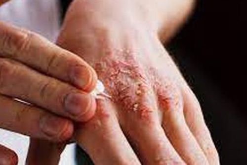 Viêm da tiếp xúc có chữa được không, cần làm gì?