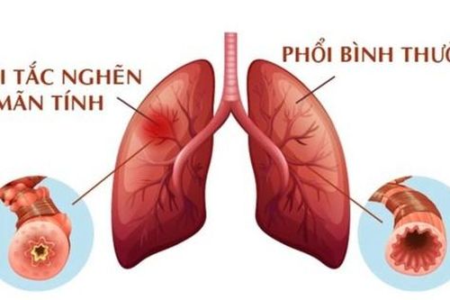 Hút thuốc lá và nguy cơ mắc bệnh phổi tắc nghẽn mãn tính