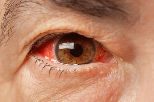 Những câu hỏi thường gặp về bệnh võng mạc