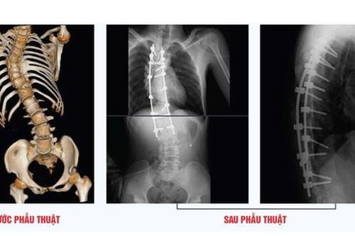 Phẫu thuật chỉnh cột sống hình chữ 'S' thành công cho thanh niên 23 tuổi