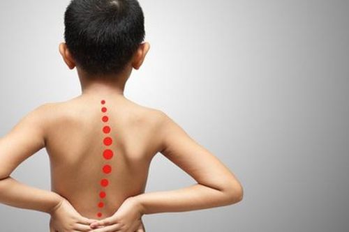 Biến chứng của cong vẹo cột sống ở trẻ em