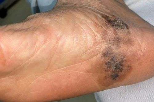 Tin tức Đời sống 24/10: Bệnh ác tính về da gia tăng trở lại