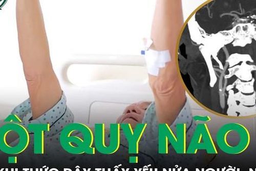 Đột nhiên yếu nửa người, mất ngôn ngữ sau khi thức dậy, phát hiện đột quỵ não