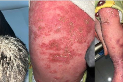 Bé trai 23 tháng tuổi bị lở loét toàn thân do tắm lá thuốc chữa vảy nến