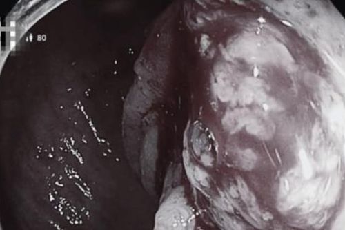 Sụt cân bất thường, đi khám phát hiện ung thư đại tràng giai đoạn cuối