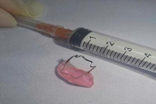 Phẫu thuật nội soi cứu bé gái nuốt phải dị vật cố định răng sau niềng