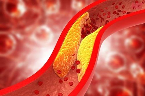 Những ai dễ bị xơ vữa động mạch?