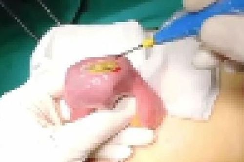 Nữ bệnh nhân tắc ruột do thói quen nhai không kỹ
