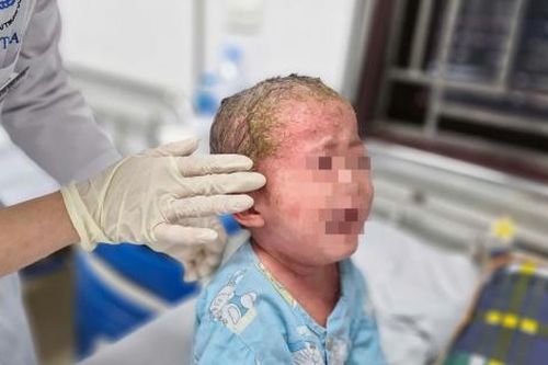 Bé 23 tháng tuổi gánh hậu quả nặng nề do điều trị vảy nến tại nhà