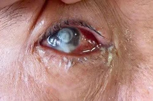 Nguy hiểm viêm loét giác mạc do trực khuẩn mủ xanh