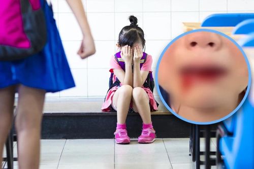 Con gái 6 tuổi bị đánh gãy răng, cha phản ứng quá 'hiền' khiến dân mạng tức giận