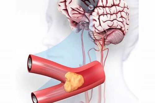 Biện pháp giảm nguy cơ thiếu máu lên não