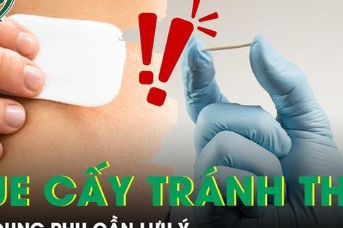 Những tác dụng phụ của que cấy tránh thai cần lưu ý