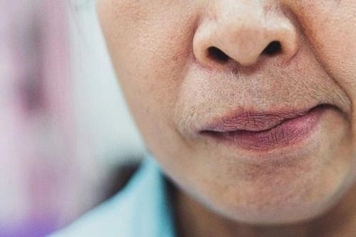 Đề phòng nguy cơ liệt mặt trong thời tiết giao mùa