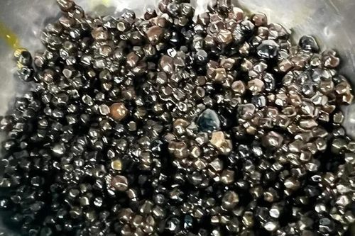 Hàng trăm viên sỏi trong túi mật của người phụ nữ