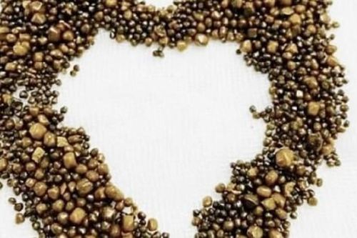 Hàng trăm viên sỏi được lấy ra từ túi mật của người phụ nữ