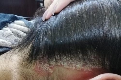 Nấm da đầu là gì? Nguyên nhân & cách cải thiện hiệu quả