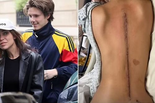 Bạn gái hơn 10 tuổi của con trai Beckham tiết lộ vết sẹo phẫu thuật khiến cô 'không thể đứng vững'