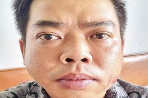 Chém bạn nhậu đứt lìa cánh tay tại tiệc đầy tháng chỉ vì mâu thuẫn hát karaoke