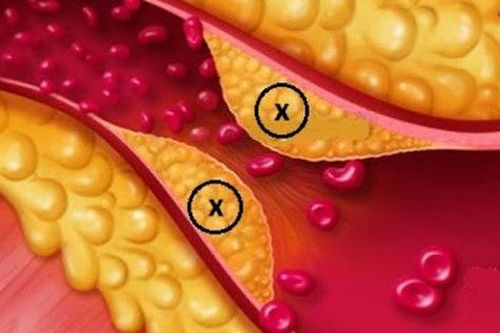 Rối loạn lipid máu nguy hiểm như thế nào?