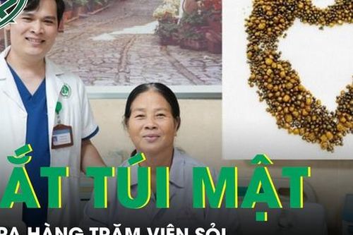 Người phụ nữ phải cắt túi mật vì cơn đau hạ sườn, lấy ra hàng trăm viên sỏi