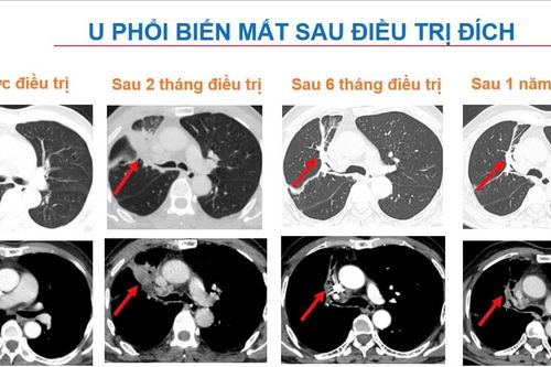 Phát hiện trường hợp viêm ruột thừa cấp tính do ung thư phổi di căn hiếm gặp