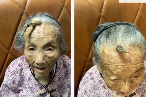 Kỳ lạ chiếc 'sừng trường thọ' dài 10cm trên trán cụ bà 107 tuổi