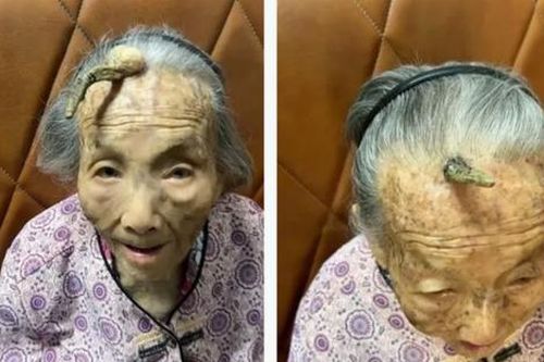 Cụ bà 107 tuổi với chiếc 'sừng trường thọ' kỳ lạ dài 10cm