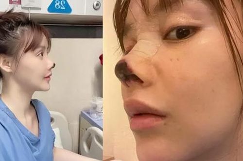 Nữ diễn viên bị rụng mũi sau khi phẫu thuật thẩm mỹ