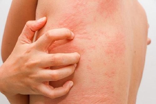 Dị ứng thời tiết cần chữa trị kịp thời