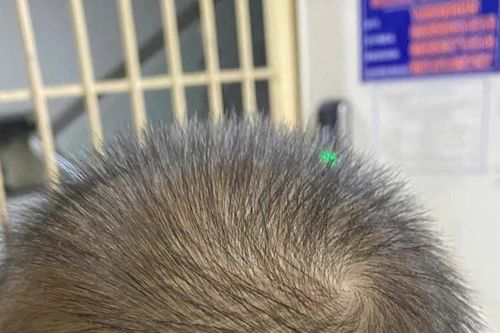 Cứu sống bé trai 2 tuổi bị đinh vít đâm vào đầu