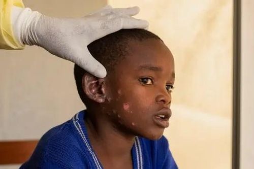 Virus đậu mùa khỉ tiến hóa, lây lan từ người sang người